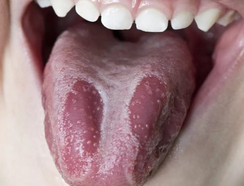 Geographic Tongue