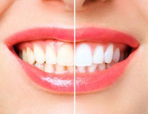 Illuminate Your Smile:Professional Teeth Whitening From DiGrazia Dentistry In Reno, NV