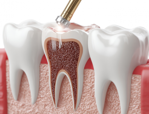 What to Expect During a Root Canal (& Why It’s Not as Scary as You Think)