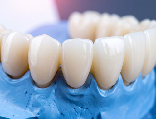 What Is a Dental Bridge? Types, Benefits & What to Expect
